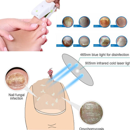 Blue Light Therapy For Nail Fungus